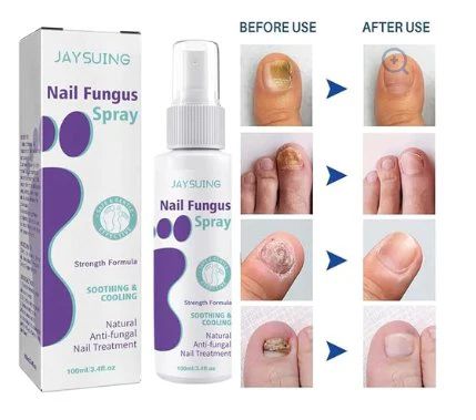 Nail Fungus Spray