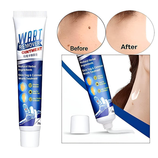 Wart Remover